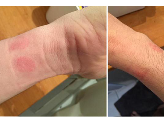 想買Apple Watch？小心皮膚過敏發(fā)紅！