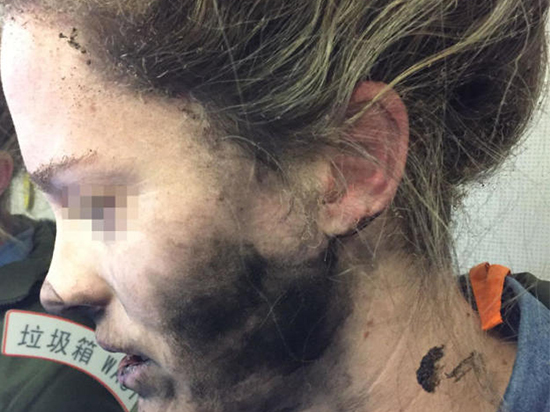 耳機(jī)爆炸燒傷用戶 蘋果：這不是我們的問題